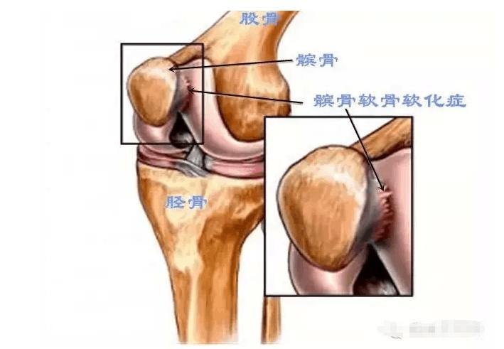 膝关节活动有响声应该看什么科室,膝关节活动有响声是怎么回事