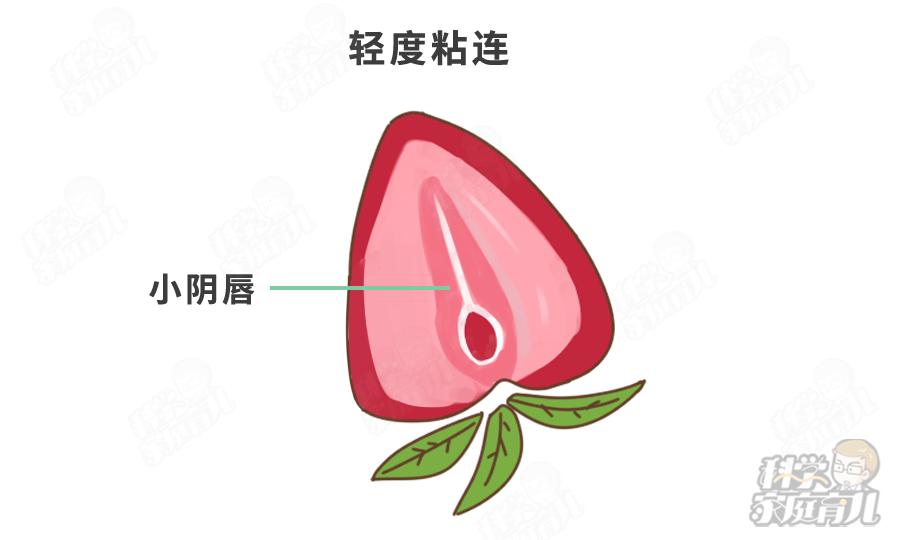 错不起！娃阴唇粘连，一碰就哭，到了这种程度，必须处理