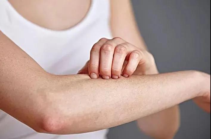 银屑病科普,银屑病痒了睡不着怎么止痒