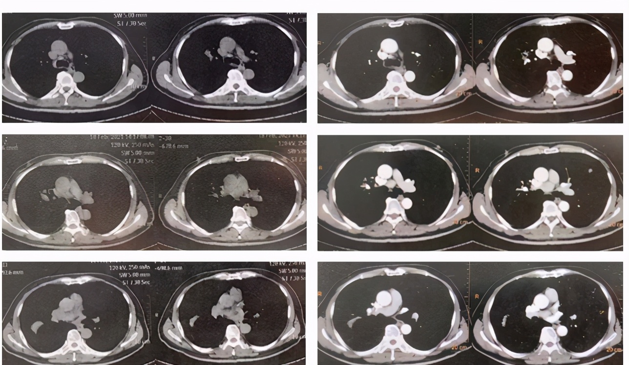 肺部肿块抗炎治疗无变化怎么办,病灶呈轻中度持续强化