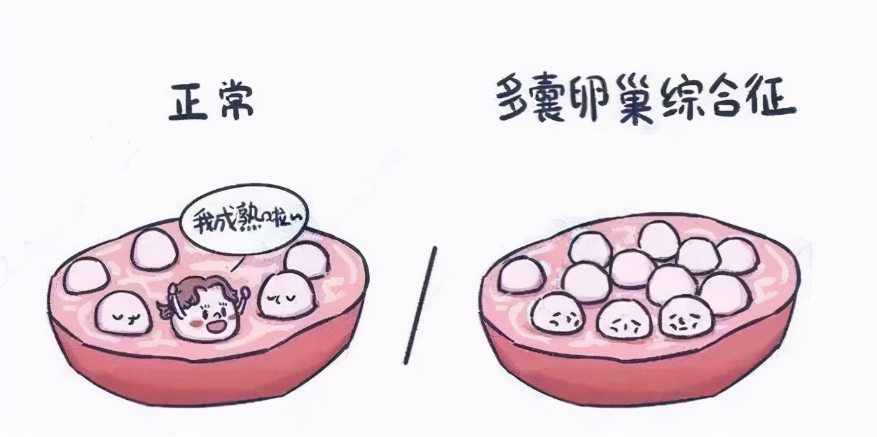 多囊朋友,卵泡为什么长不大,排不出?