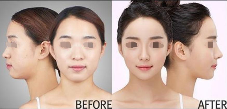 脸颊凹陷医美怎么改善,十全九美