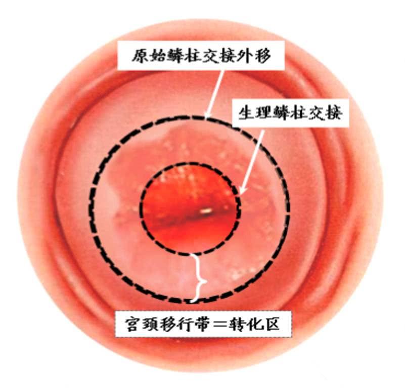 宫颈糜烂囊肿肥大需要怎么治疗呀,卵巢囊肿和宫颈糜烂可以一起治吗