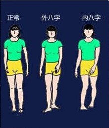 一岁的孩子走路八字脚怎么回事,宝宝刚学走路八字脚正常吗