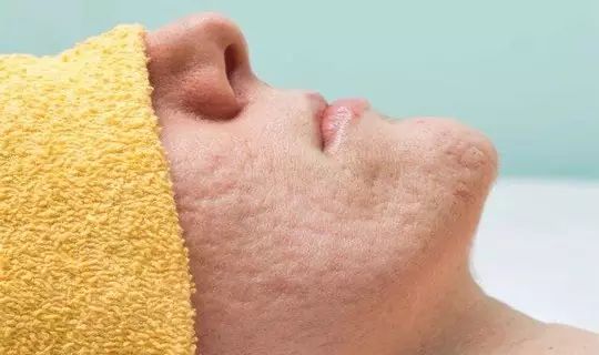 毛孔粗大痘印痘坑修复的护肤方法,有痘印痘坑怎么用护肤品消除