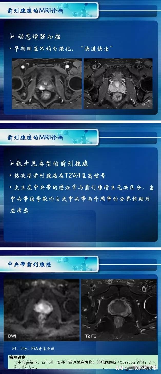 前列腺磁共振影像解剖,前列腺mri正常诊断报告模板