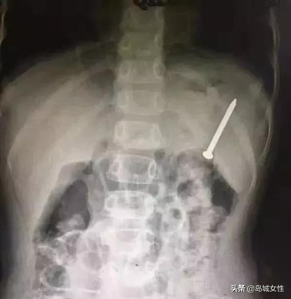8岁男孩误吞5厘米钢钉,惊险9岁男孩误吞3厘米图钉
