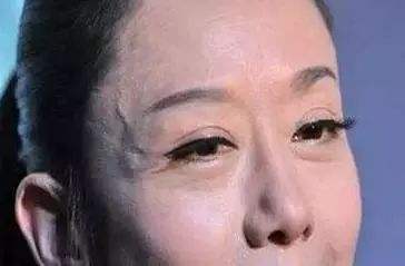 头部血管突出青筋暴起是什么原因,头部青筋