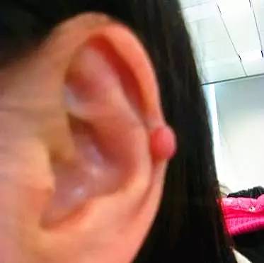 这些小疙瘩暗示肿瘤来临，赶紧看看！为您的健康快收藏！