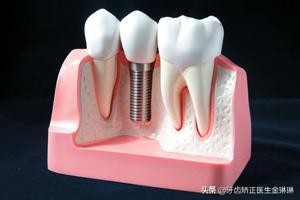 我左下连着三颗大牙没了怎么镶,孩子6岁大牙都腐蚀没了怎么办