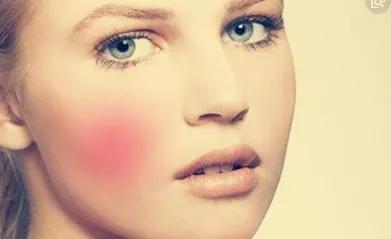 脸上长“*血丝红**”，医生：平时的坏习惯要纠正！