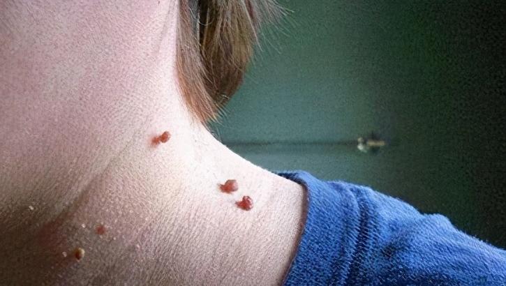 脖子上的小肉球用啥药膏能去掉,脖子上的小肉球怎么治疗