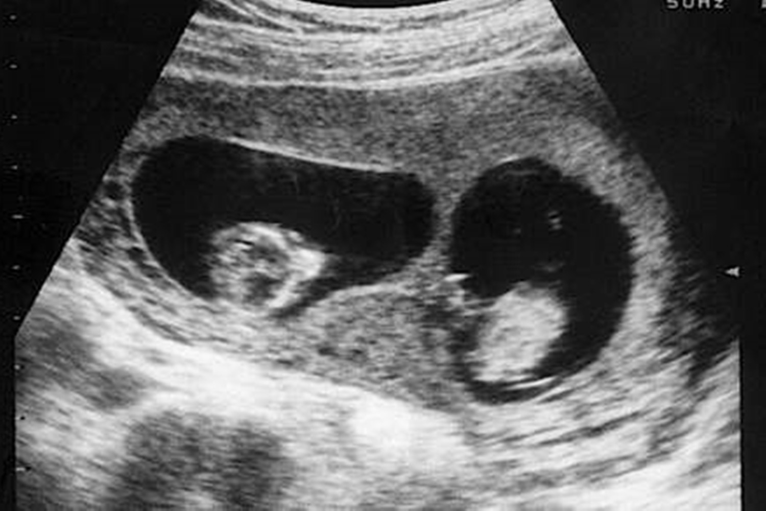 龙凤胎姐姐被抱养,双胞胎妹妹身上有胎记