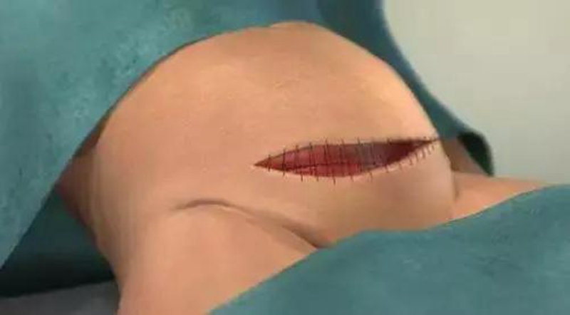 一分钟让你见证剖腹产,一分钟看懂剖腹产