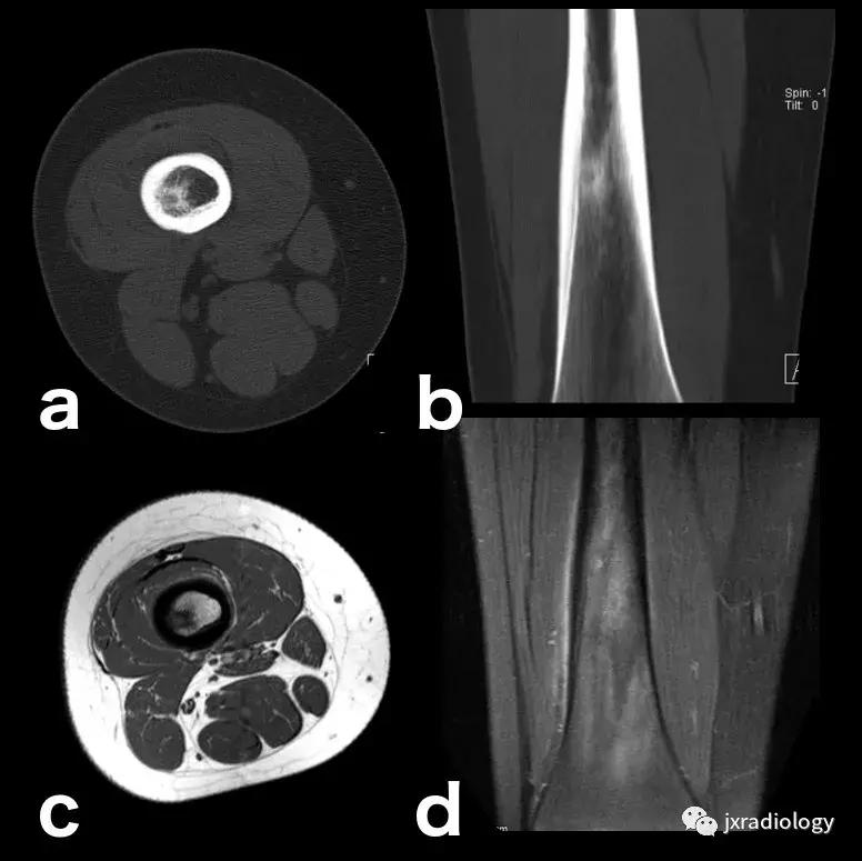 磁共振骶髂关节骨髓水肿是强直吗,磁共振显示骨髓水肿什么意思
