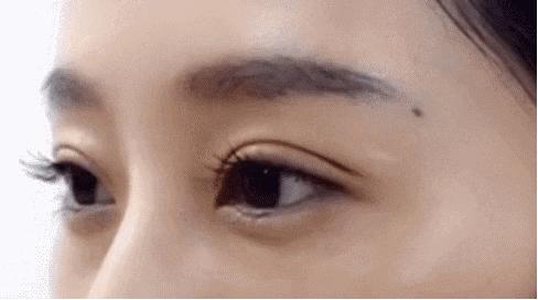 双眼皮拆线后不对称怎么回事,拆线后双眼皮不对称