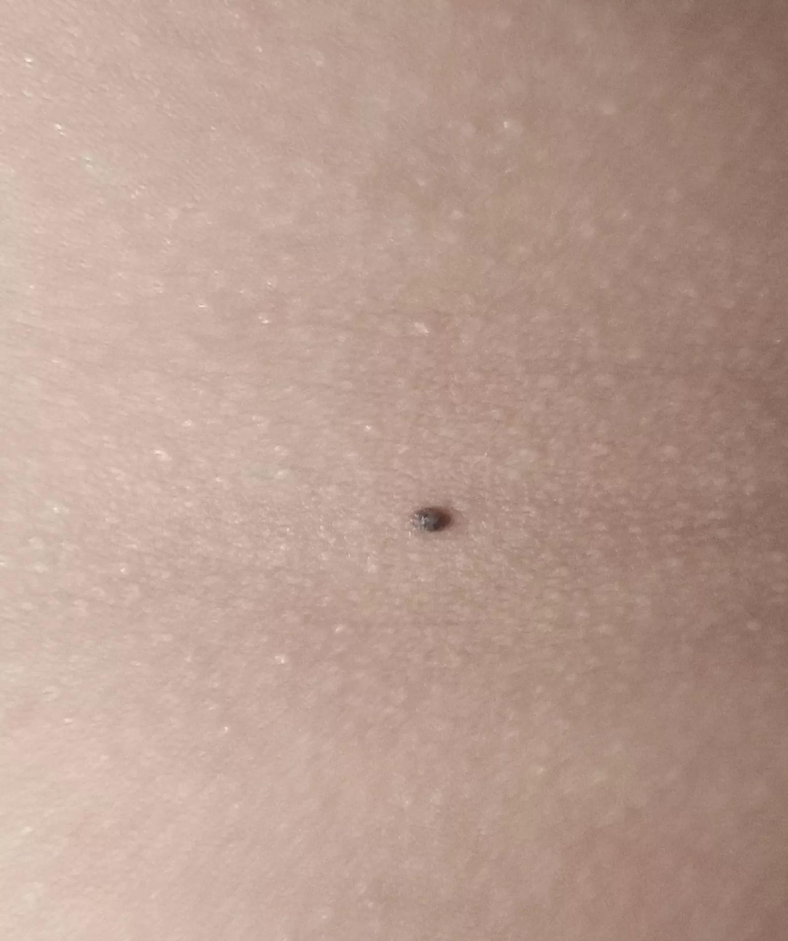 小孩身上有小黑点怎么回事,小孩身上小黑点越来越多