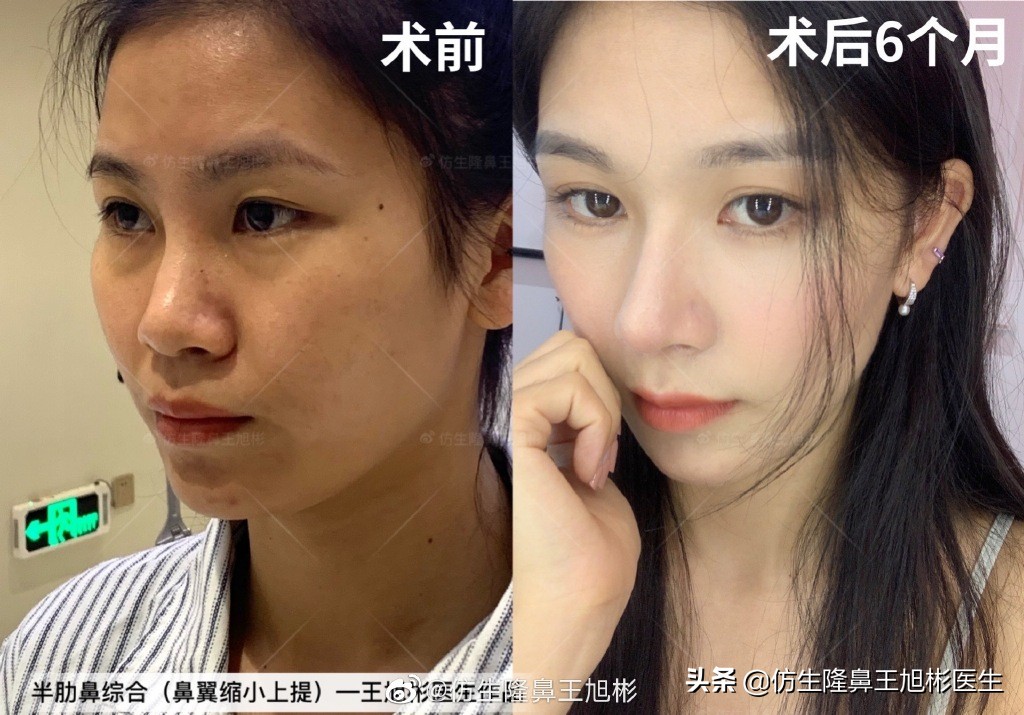 那些被鼻子“封印”颜值的鼻综合/修复案例|广州鼻整形