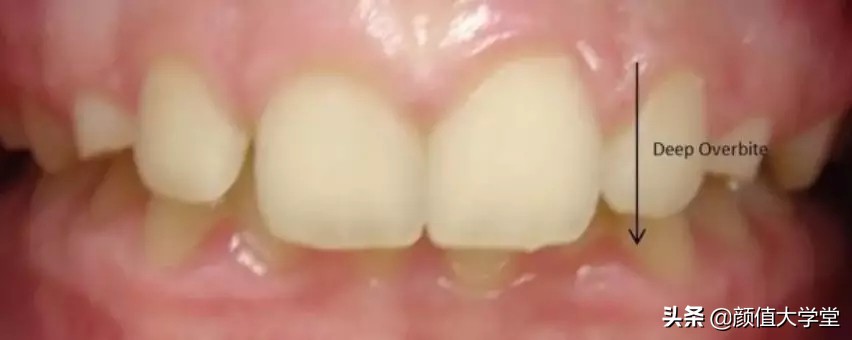 下巴后缩怎么拍侧颜,下巴后缩需要怎么矫正