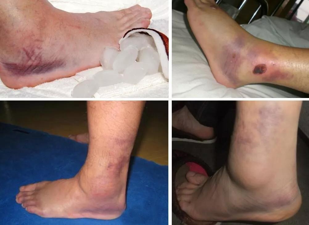 跑步后腿疼治疗办法有哪些,跑步腿疼脚疼怎么回事