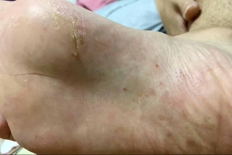 脚上真菌感染脱皮干裂怎么办,脚上脱皮又痒是真菌感染