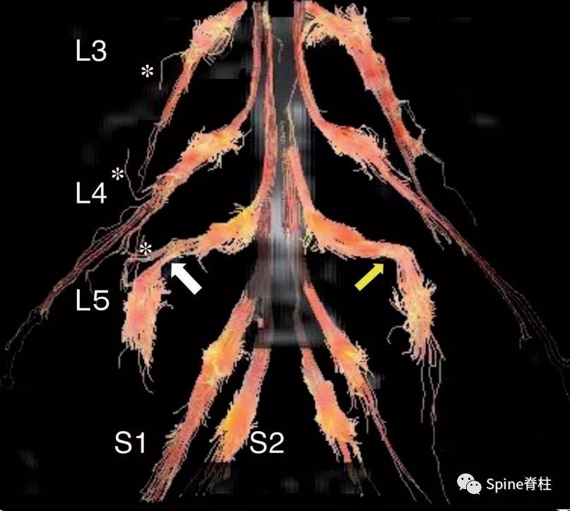 下肢疼痛是腰椎间盘突出引起的吗,下肢放射痛查不出原因