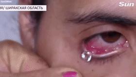 女子得了罕见怪病眼睛流出血,女子眼睛流出钻石眼泪