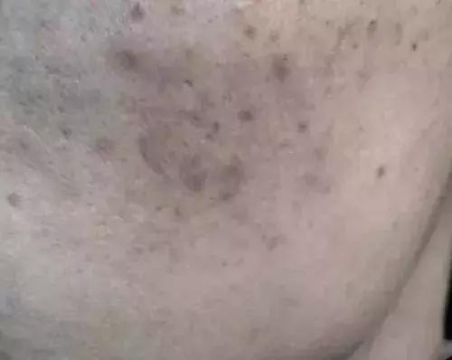 痘印很顽固怎么祛痘印,痘印祛痘药膏