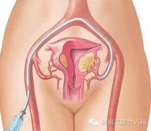 血管介入科主治,介入手术治疗妇科疾病