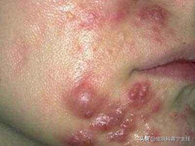 宅家的1个多月都没化妆,竟然还爆痘