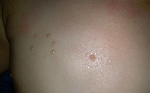 传染性软疣高发的人群及症状表现,传染性软疣初期有哪些症状