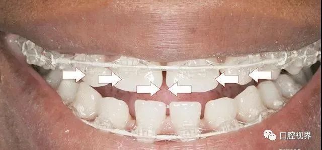 听说牙缝太大难看又露财，您给看看这牙缝还有救吗？