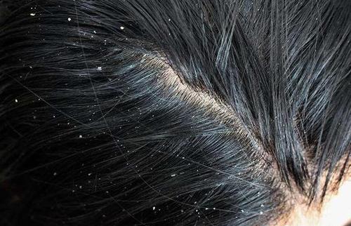 头皮上抠出白皮是头皮屑吗,头皮屑白泥是什么