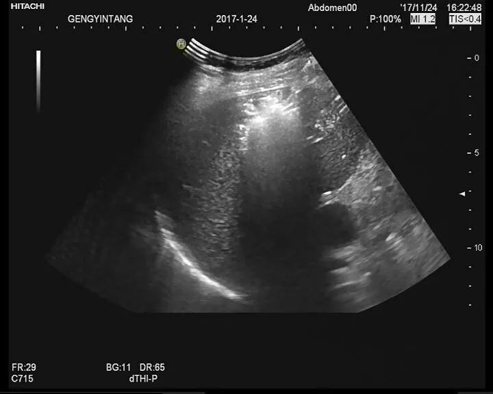 异位妊娠如果处理不当，会影响患者后续怀孕，需要尽早治疗