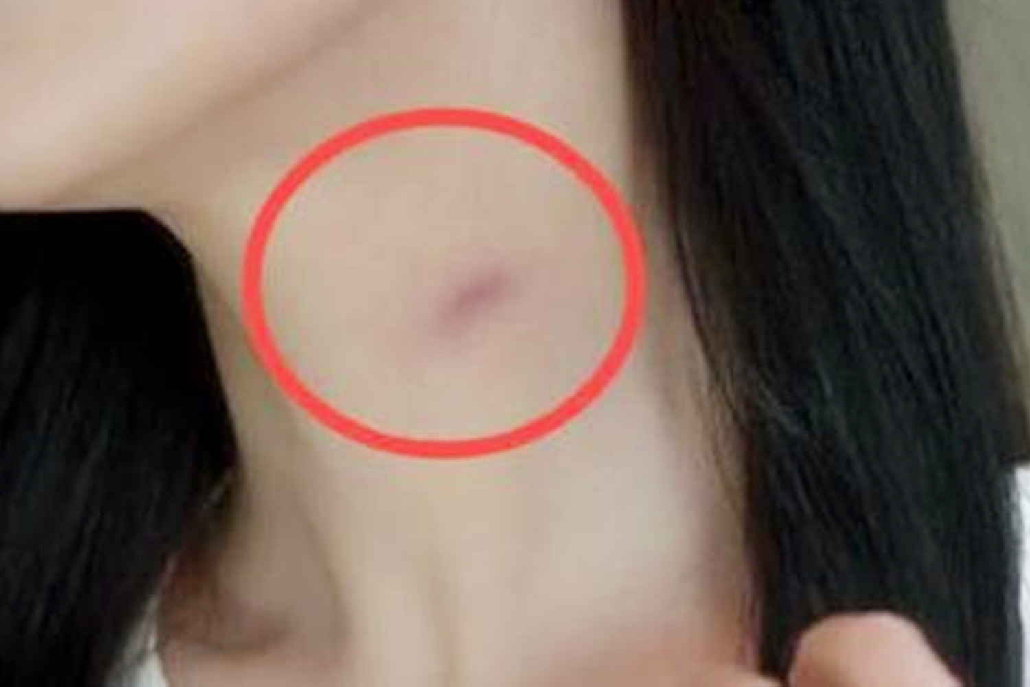 13岁的女孩脖子有很多红点,13岁女孩脖子上长了纹路