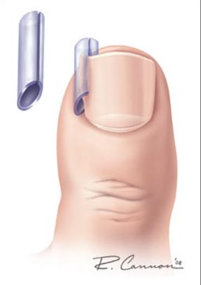 什么原因导致脚趾甲老是嵌甲,脚趾甲老是长到肉里怎么治疗啊