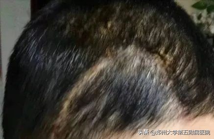 最先进有效的癫痫手术,癫痫手术是否能一次治愈