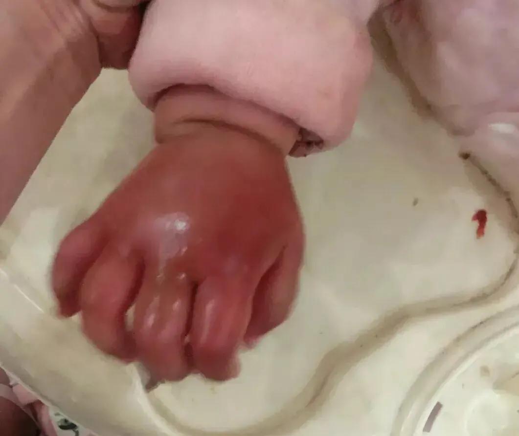 宝宝被蚊虫叮咬用什么药消炎消肿,宝宝被蚊虫叮咬了怎么快速消除