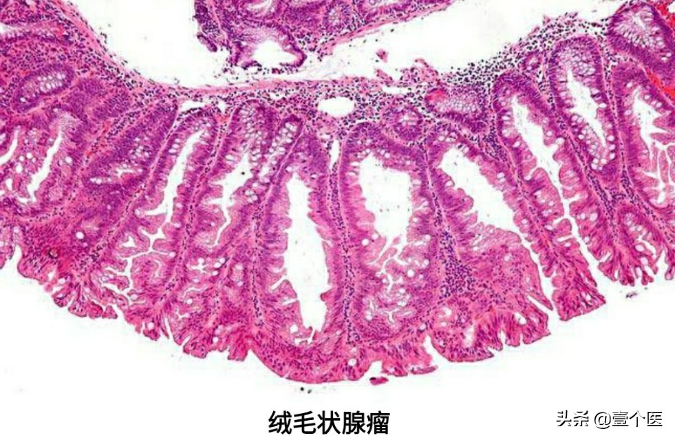 病理单上的癌前病变、非典型性增生及原位癌还是傻傻分不清？