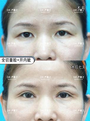 可以只做泪沟不做眼袋吗,上睑下垂矫正不做双眼皮可以吗