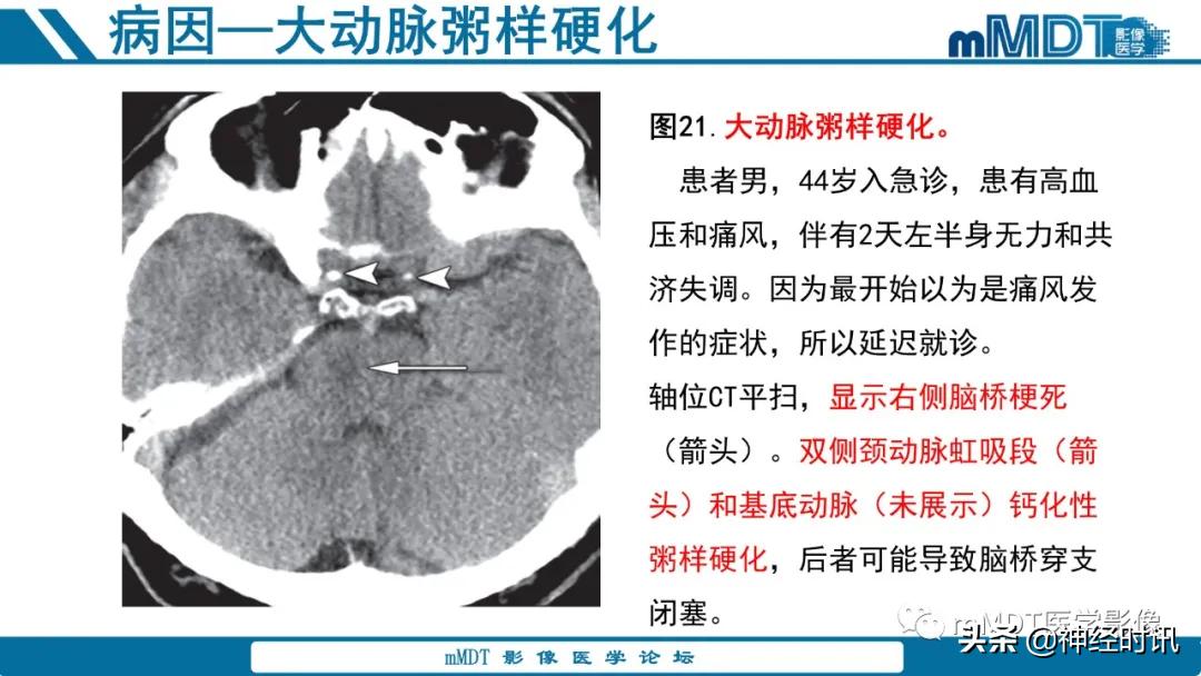 缺血性脑卒中护理课件,缺血性脑卒中讲课ppt