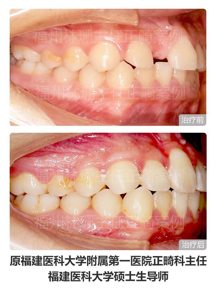 牙齿矫正仍然没整齐,异位正常牙齿矫正不过来怎么办