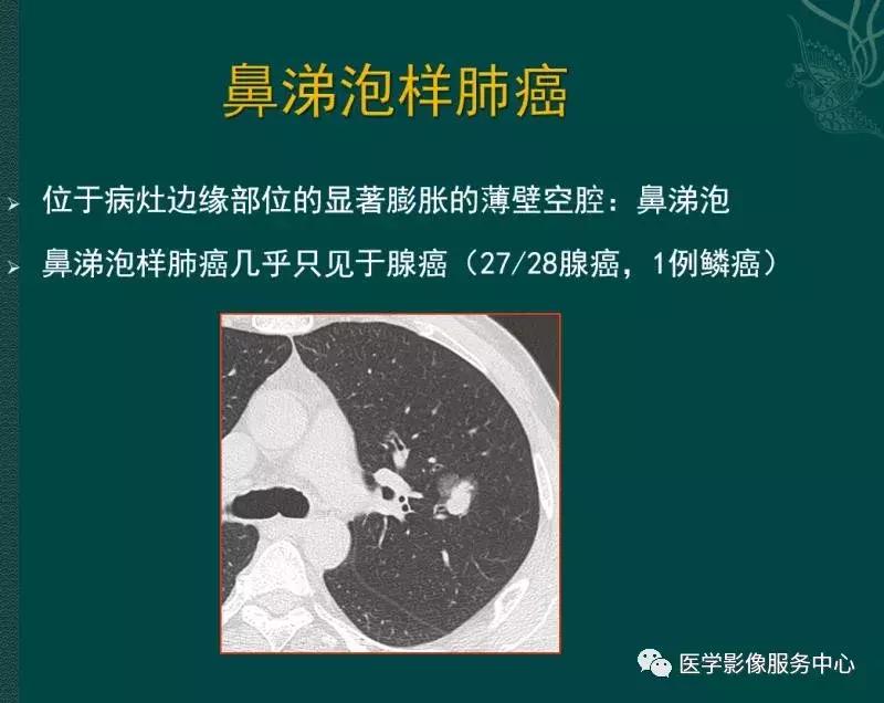肺癌复查出现多发索条状阴影,肺癌影像学表现