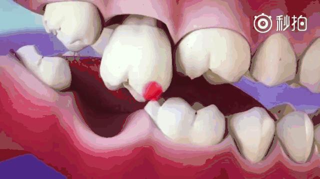 牙齿缺失后不镶牙有啥危害,牙齿缺失后不补有什么危害