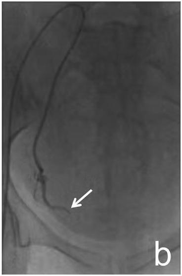 举例科普|介入能治疗哪些疾病?