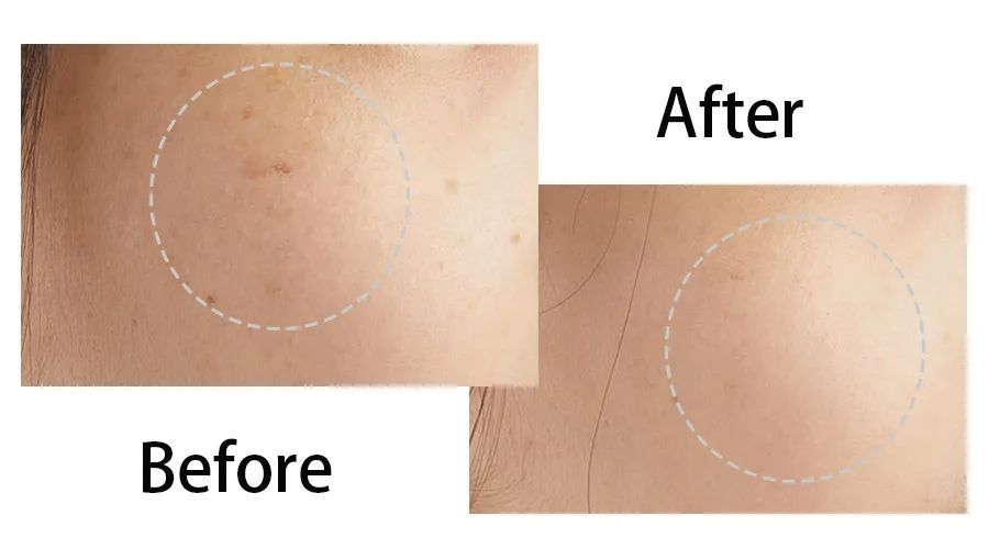 目前为止最温和无伤害的祛斑方法,揭秘有效祛斑方法大爆料