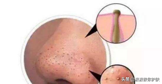 怎么解决男士毛孔粗大,如何解决男士毛孔粗大