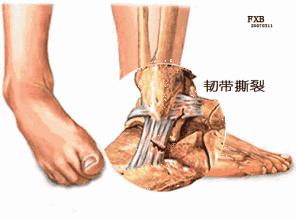习惯性脚踝扭伤3年怎么治疗,习惯性扭伤脚踝隐隐作痛