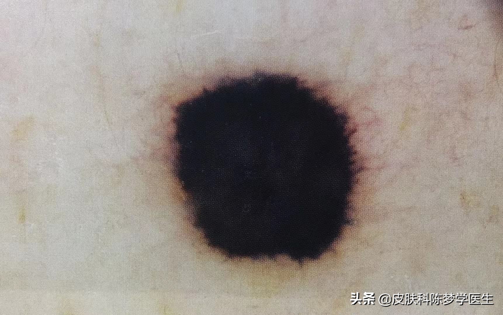 激光点痣适合多大的痣,激光点痣以后痣晕开了怎么办