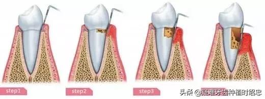 牙周炎导致牙齿松动严重怎么办,重度牙周炎导致牙齿松动